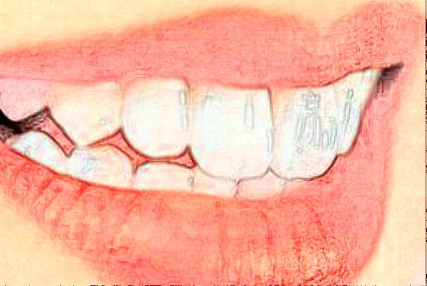 2024杭州植得口腔門診部地包天矯正做的好嗎
