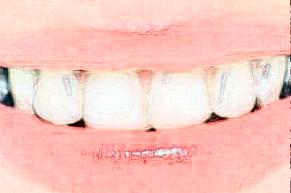 延安牙衛(wèi)士口腔樹脂補牙價格(價目)_案例_