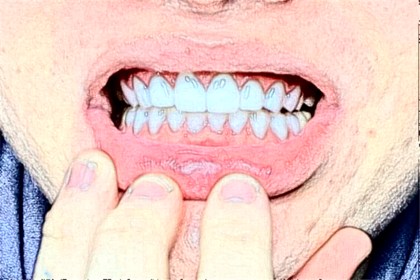 鄭州唯美口腔醫(yī)院種植牙價(jià)格多少?整形日記全過程分享