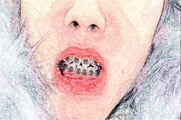 成都圣貝牙科醫(yī)院樹脂補(bǔ)牙好的醫(yī)生推薦_美容日記展示