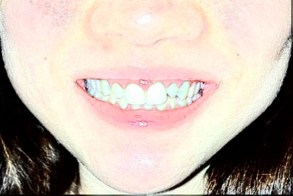 深圳樂(lè)莎莎口腔醫(yī)院超聲波洗牙原理?超聲波洗牙疼不疼