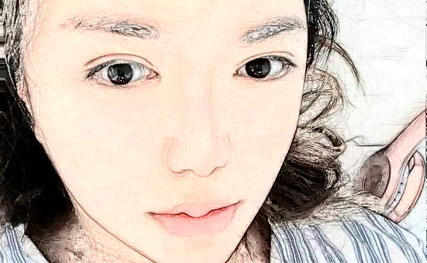 鄭州華領(lǐng)醫(yī)療美容醫(yī)院除皺三個月術(shù)后案例反饋(效果怎么樣?技術(shù)評價)