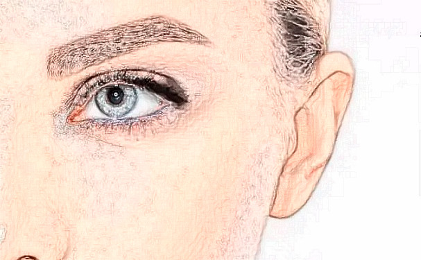 惠州鵬愛醫(yī)療美容醫(yī)院膠原蛋白除皺90天案例恢復過程&費用多少?