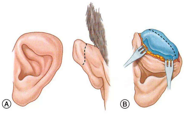 蘇州常春藤整形醫(yī)院耳朵矯正怎么樣?費(fèi)用標(biāo)準(zhǔn)?經(jīng)驗(yàn)案例&技術(shù)亮點(diǎn)