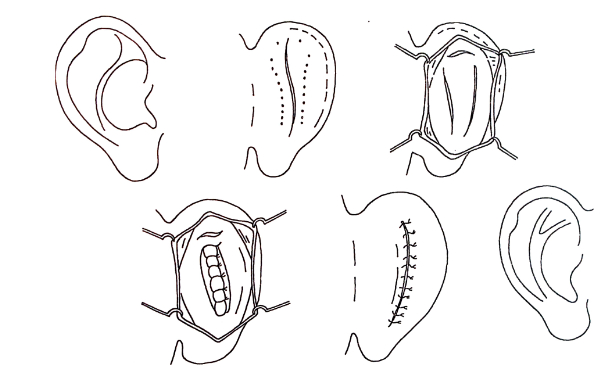 華中科技大學(xué)同濟(jì)醫(yī)學(xué)院醫(yī)院杯狀耳矯正術(shù)后三個(gè)月案例曝光|技術(shù)能力怎么樣?費(fèi)用多少