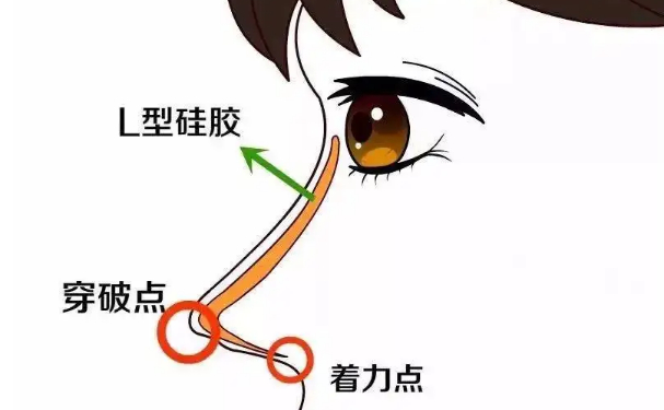 王志富醫(yī)療美容自體隆鼻120天案例點評&技術怎么樣?