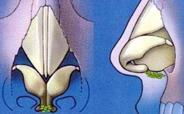 鄭州市蘊(yùn)美醫(yī)療美容耳軟骨隆鼻術(shù)后三個月案例欣賞&技術(shù)怎么樣?