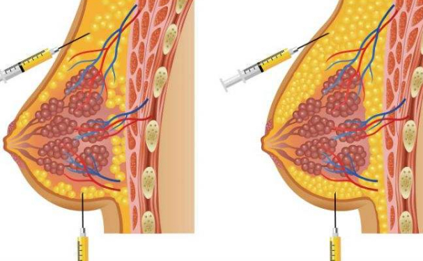 濟(jì)寧任城壹美天成醫(yī)療美容醫(yī)院自體脂肪隆胸術(shù)后半年求美案例(效果怎么樣?技術(shù)等級(jí))
