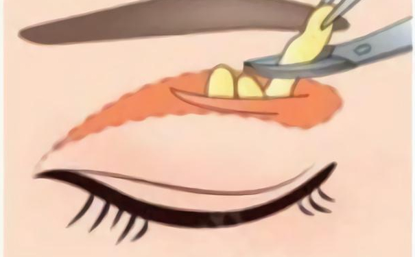 廣州愛(ài)萊美醫(yī)療美容門診做雙眼皮技術(shù)怎么樣?120天案例點(diǎn)評(píng)