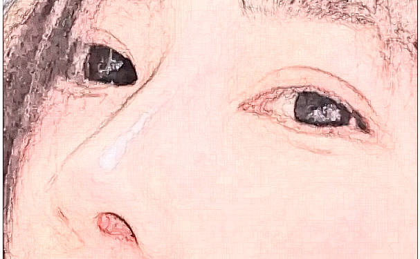 泰安雅汀醫(yī)學美容診所腫泡眼雙眼皮價格查詢?技術優(yōu)點怎么樣?