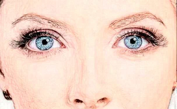 杭州顏控醫(yī)療美容埋線雙眼皮技術怎么樣?90天恢復案例