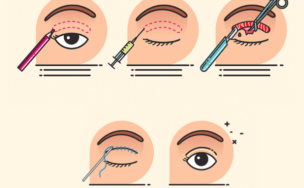 安徽立新整形美容雙眼皮技術(shù)怎么樣?價(jià)格一覽表?一年術(shù)后案例反饋