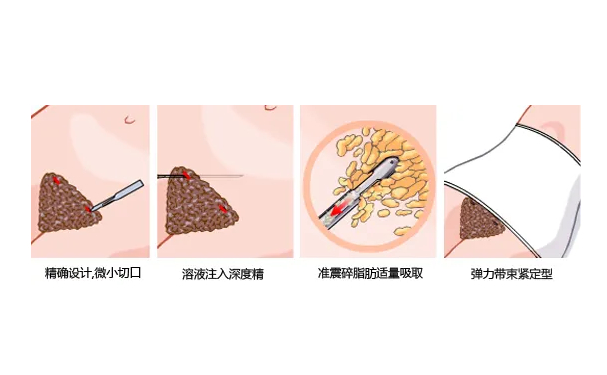 佛山順德壹加壹美容醫(yī)院共振吸脂技術級別怎么樣?案例點評&費用明細