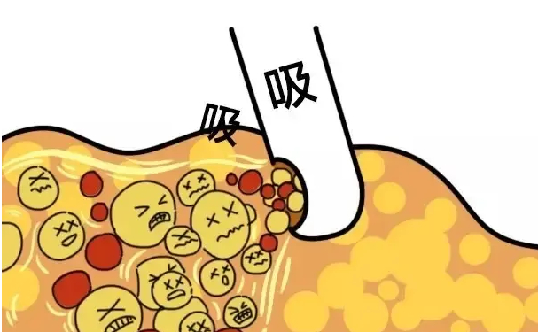 華亦俏醫(yī)療美容吸脂減肥60天親測案例全解|技術特色怎么樣?價格明細