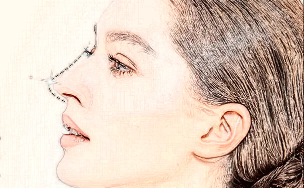 武漢碧蓮盛醫(yī)療美容門診部頭發(fā)種植術(shù)后三個月經(jīng)典案例(效果怎么樣?技術(shù)評價)