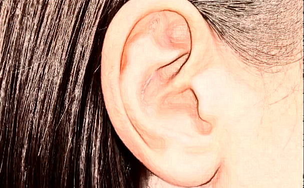 中國醫(yī)科大學(xué)附屬口腔醫(yī)院張蕾招風(fēng)耳矯正技術(shù)怎么樣?收費(fèi)多少?野生案例