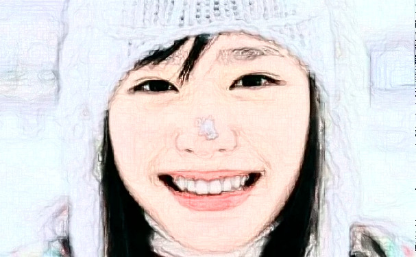 鄭州大學(xué)第一附屬醫(yī)院鄭東院區(qū)唐曉娟去眼角細(xì)紋案例細(xì)節(jié)&價(jià)格一覽表?