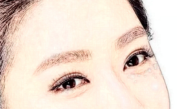 四川大學華西醫(yī)院于蓉割雙眼皮技術怎么樣?費用多少?求美案例